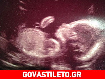 Ηθοποιός μάς έδειξε το υπερηχογράφημα του μωρού της